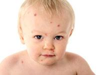 chickenpox on baby rash