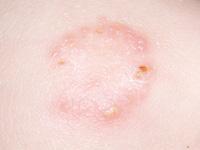 ringworm rash on baby