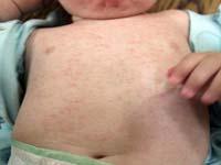 roseola rash on baby
