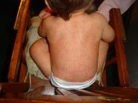 roseola on baby