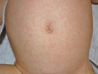 roseola on baby