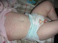 viral rash on baby