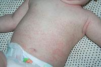 viral rash on baby