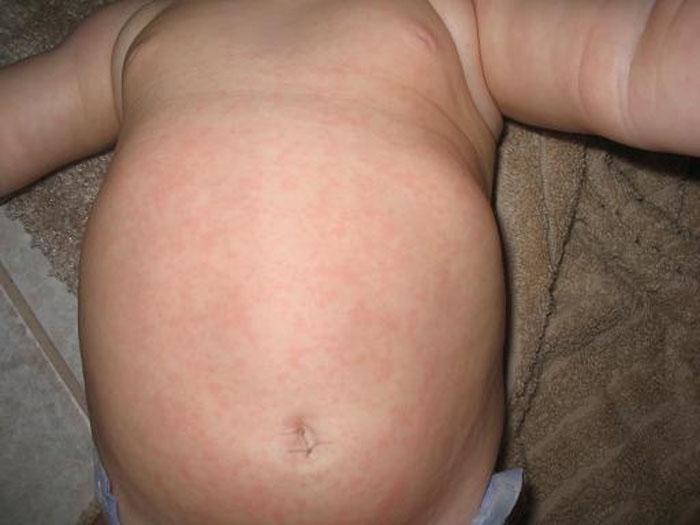 Viral Rash Baby Pictures Photos Vrogue