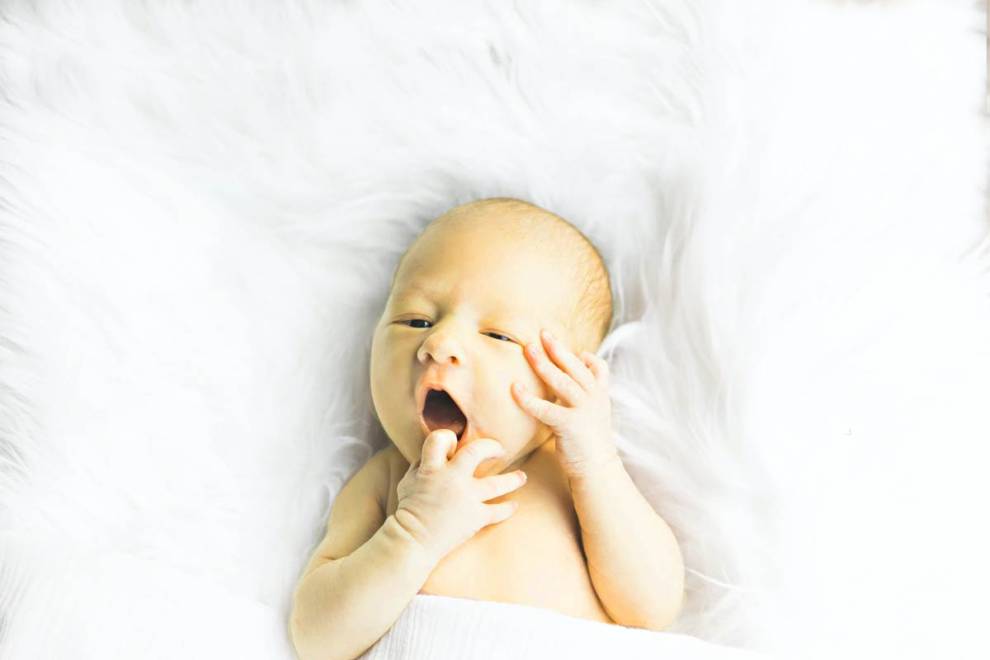 Infant Jaundice Pictures