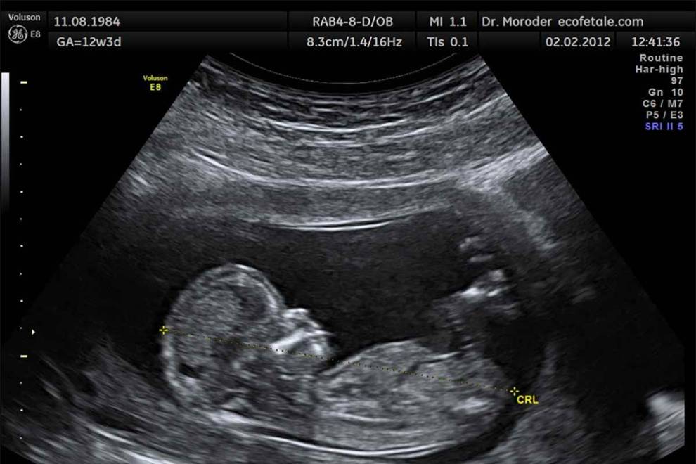 Find Out Your Baby's Sex at the FIRST Ultrasound! The Ramzi Method.