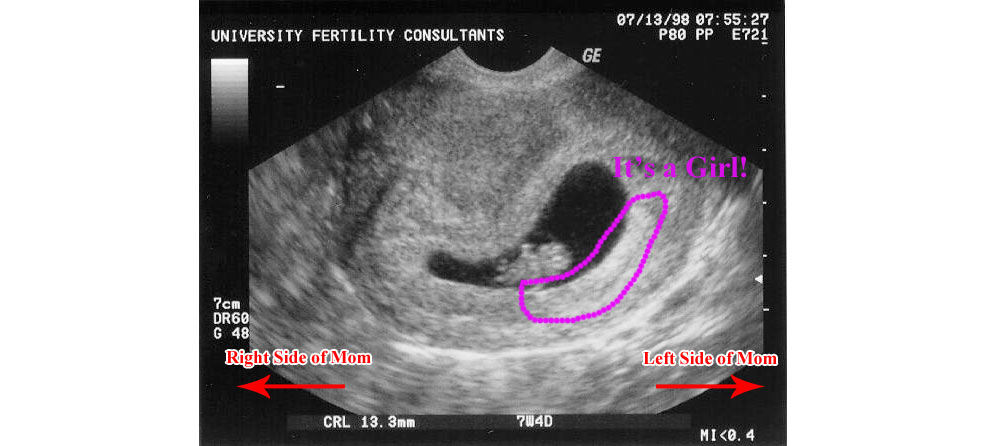 first ultrasound ramzi method boy girl sex gender baby fetus