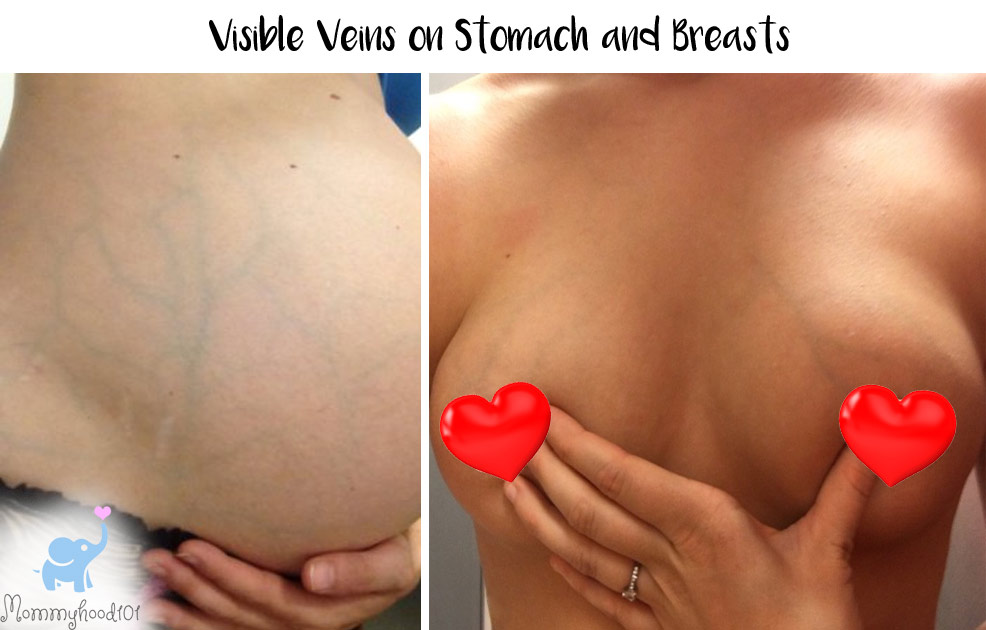 veins on breasts and stomach pregnancy